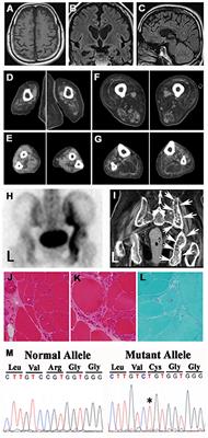 Increased Neurofilament Light Chain and YKL-40 CSF Levels in One Japanese IBMPFD Patient With VCP R155C Mutation: A Clinical Case Report With CSF Biomarker Analyses